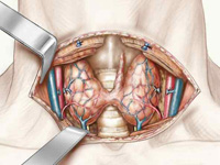 LA CHIRURGIE THYROÏDIENNE